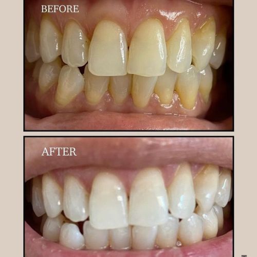 Optimized Oil Pulling Formula