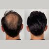 4 Mens Hair Loss Treatment