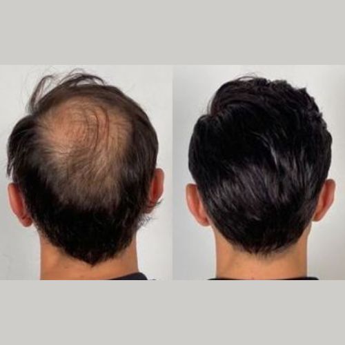 4 Mens Hair Loss Treatment