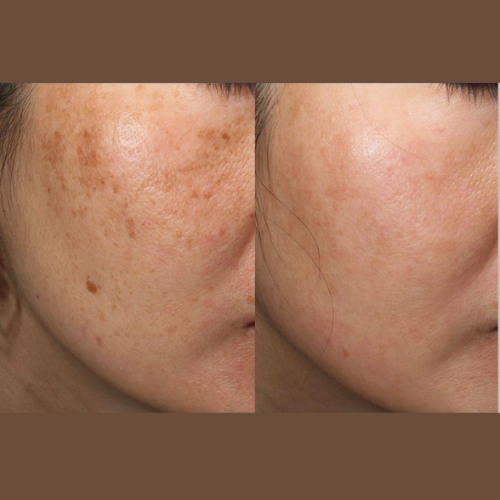 Exfoliation Formula