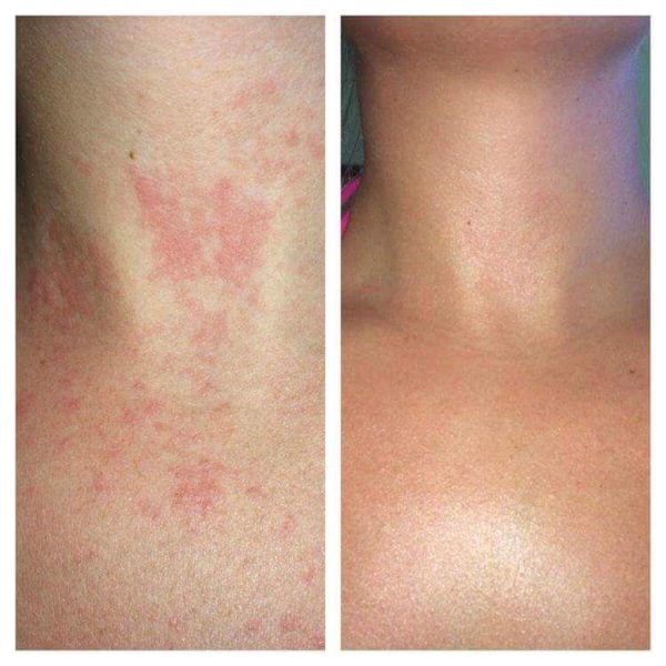 Tea Tree Oil + Lavender Oil + Black Seed Oil